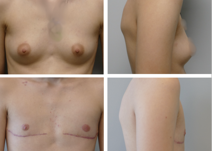 top surgery results